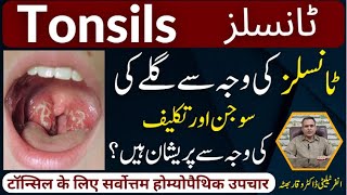 Tonsils گلے کی سوجن اور تکلیف टॉन्सिल Homeopathic Treatmennt By Dr Waqar Bhutta In Urdu  Hindi [upl. by Kiyohara574]