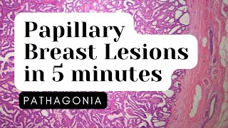 Papillary Neoplasms of Breast 5 Minute Overview pathagonia [upl. by Dnomsad]