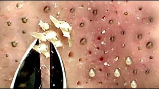 Best Satisfying Nose Plucking Blackheads Whiteheads Removal  Acne Treatment 20 [upl. by Jyoti649]