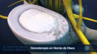 IAOT 3D Ozonoterapia en Hernia de Disco [upl. by Natelson]