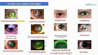 Optician Training Pathology Recognition Ocular Anatomy Lecture 28 [upl. by Tnomel]