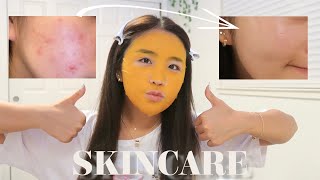 【SKINCARE】The BEST Skincare Routine for Acne Prone Skin [upl. by Winzler]