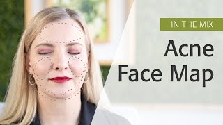 Acne Face Map  Eminence Organics [upl. by Lindgren]