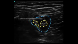 Popliteal block ultrasound guided classic technique [upl. by Adian]