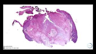 Gout Tophus Watch to find out why this used to be called the quotDisease of Kingsquot Dermpath Made Easy [upl. by Lemraj762]