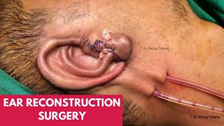 Microtia reconstruction by Dr Parag Telang [upl. by Ttenaj]