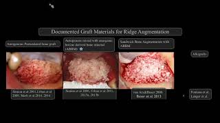 AO Webinar Rewind quotNew Perspectives on Vertical Ridge Augmentationquot Istvan Urban DMD MD PhD [upl. by Merridie]