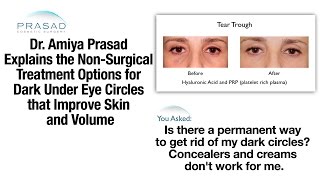 Under Eye Dark Circle Treatment Using PlateletRich Plasma and Hyaluronic Acid Fillers [upl. by End]