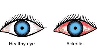 ScleritisEpiscleritis  in very easy way eyedisorders scleritis episcleritis shalakyatantra [upl. by Ahsenahs354]