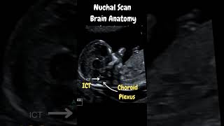 Ultrasound Nuchal Scan Must know Important Brain Anatomy [upl. by Oalsinatse]