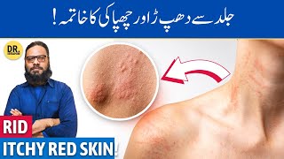 KharishDhapper Ka Ilaj  Treat UrticariaHives on Skin  Dr Ibrahim [upl. by Entwistle]