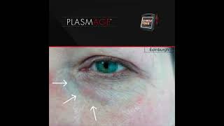 Remove Xanthelasma with Plasmage ®  such a simple and fast operation [upl. by Pinsky]