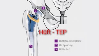 Was ist eine Hüft  TEP Ursache Diagnose und Therapie [upl. by Ho]