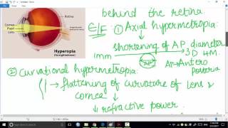 hypermetropia part 1  ophthalmology [upl. by Merow436]