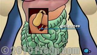 Gallbladder Removal Laparoscopic PreOp® Patient Education Feature [upl. by Hicks934]