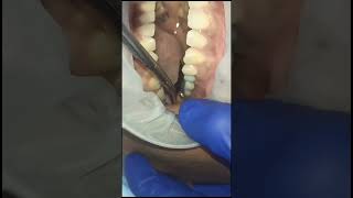 Left upper premolar molar replacement with basal implants and g cam bridge 40 micron clearance test [upl. by Debi]