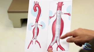 Complex Abdominal Aortic Aneurysm Surgery [upl. by Zechariah556]