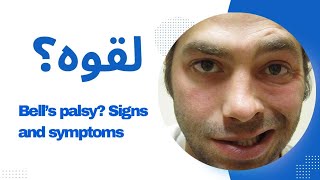 Bells Palsy  Comprehensive Overview of Symptoms and Signs [upl. by Hgielah]