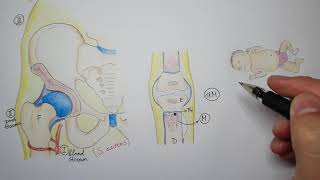 Hematogenous osteomyelitis in children [upl. by Peg]