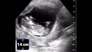 12 week 2 day ultrasound [upl. by Marler600]