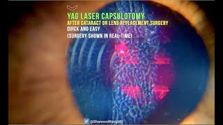 Everything you need to know about YAG LASER capsulotomy in 30 seconds [upl. by Jariah]