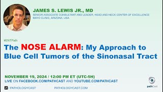 ENTPATH The NOSE ALARM My approach to Blue Cell Tumors of the Sinonasal Tract [upl. by Errehs470]