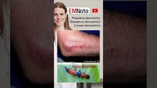 Paederus Linear Dermatitis medical doctor nursing [upl. by Ide236]