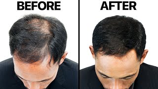 Finasteride Propecia For Hair Loss [upl. by Inama33]