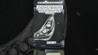 MRI Ankle Showing tenosynovitis in t2tsesag Sequence beginners [upl. by Piper248]