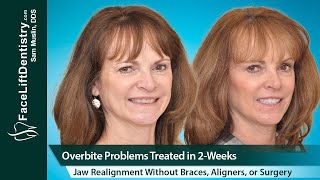 Overbite Problems Treated Jaw and Bite Realignment Without Braces Aligners or Surgery [upl. by Radford]