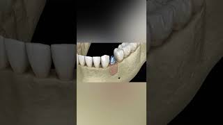 Augmentation Surgery  Adding new bone and implant medicalanimation dentist [upl. by Eiba409]