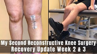 My Second Reconstructive Knee Surgery  Week 2 amp 3 Recovery Update  TTO MPFL amp Lateral Lengthening [upl. by Sky]