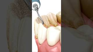 Scaling technologydentalhygiene [upl. by Eelarol]