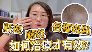 肝斑、色素不均是如何造成？來看看莊盈彥醫師治療肝斑的方式有哪些！ [upl. by Yeldahc]