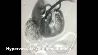 Renal Angiomyolipoma AML Transcatheter Ethanol Alcohol Embolization [upl. by Nilat]