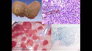 HEMOSIDEROSIS Y HEMOCROMATOSIS • FISIOPATOLOGIA MÉDICA [upl. by Esch928]