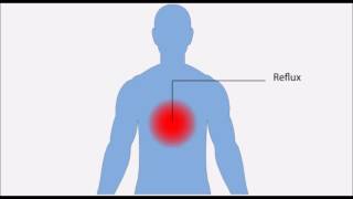 Oesophagite inflammation de l’oesophage [upl. by Nedloh706]