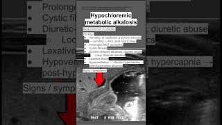 Hypochloremic metabolic alkalosis [upl. by Aivatnohs]