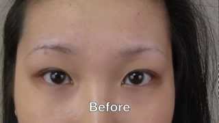 Eyebrow Transplant Amazing Results [upl. by Ecile940]