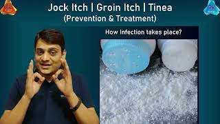 Jock Itch  Prevention and Treatment  जाँघों के बीच खुजली और दाद का इलाज  Fungal Infection [upl. by Aikemit]