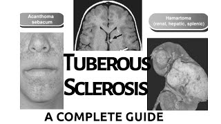 Tuberous Sclerosis Complex  Rare Disease  Seizure Disorder ampEpilepsy  Simplified Sign amp Symptom [upl. by Barnett867]