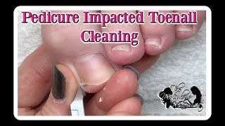 Pedicure How to Clean Impacted Toenails ⭐ [upl. by Gilud]