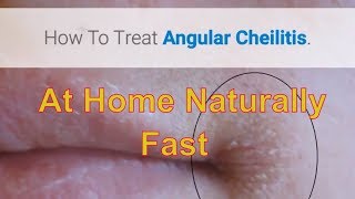 How To Treat Angular Cheilitis Naturally At Home Remedy That Works [upl. by Ydnor]