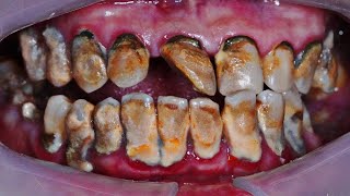 55 yo Females Teeth  This Is So Awesome  Full Of Tartar  Dokter Gigi Tri Putra [upl. by Oivat]