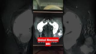 Gluteal Abscess MRI shorts shortsvideo youtubeshorts MRi Abscess [upl. by Anbul]