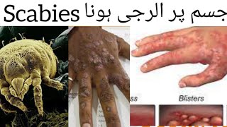 Scabies Causes Symptoms Diagnose Treatment Medicine for Scabies in HindiUrdu skin Disease [upl. by Sperry]