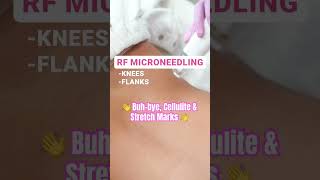 Now offering RF Microneedling on new areas [upl. by Honig]