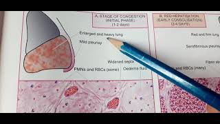 Lobar Pneumonia Revision MBBS PATHOLOGYEtiopathogenesis Gross Microscopic features complications [upl. by Lutero]