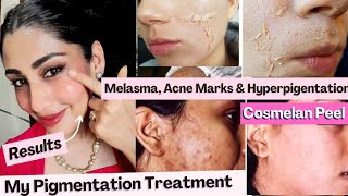 COSMELAN PEEL Best Skin Peel for Hyperpigmentation Acne marks Melasma treatment at home Dr Menka [upl. by Strohben]