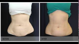 SculpSure treatment  Before and After pics [upl. by Atwekk]